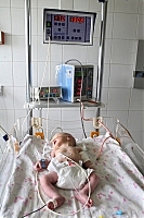 Ужгородські лікарі вихожують недоношених немовлят