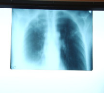 Уже цього року в Берегівській райлікарні виявили 20 нових випадків туберкульозу (ВІДЕО)