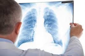 Торік на Закарпатті "стаціонарно" лікувалися від туберкульозу понад 1,5 тисячі пацієнтів