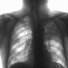Медики стверджують, що на Закарпатті рівень захворюваності на туберкульоз із кожним роком зменшується (ВІДЕО)